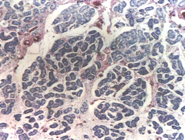 Fig.5: Caso 2.Ovotestis, compartimento testicular - <div style=